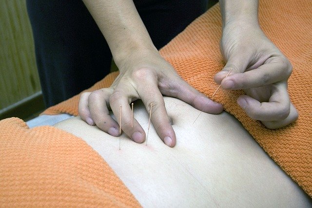 acupuncture anxiety treatment